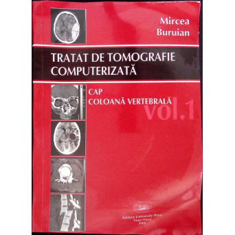 TRATAT DE TOMOGRAFIE COMPUTERIZATA VOL.1 CAP, COLOANA VERTEBRALA