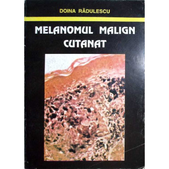 MELANOMUL MALIGN CUTANAT MELANOMUL MALIGN CUTANAT