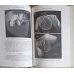 COMPUTED TOMOGRAPHY IN RADIATION THERAPY