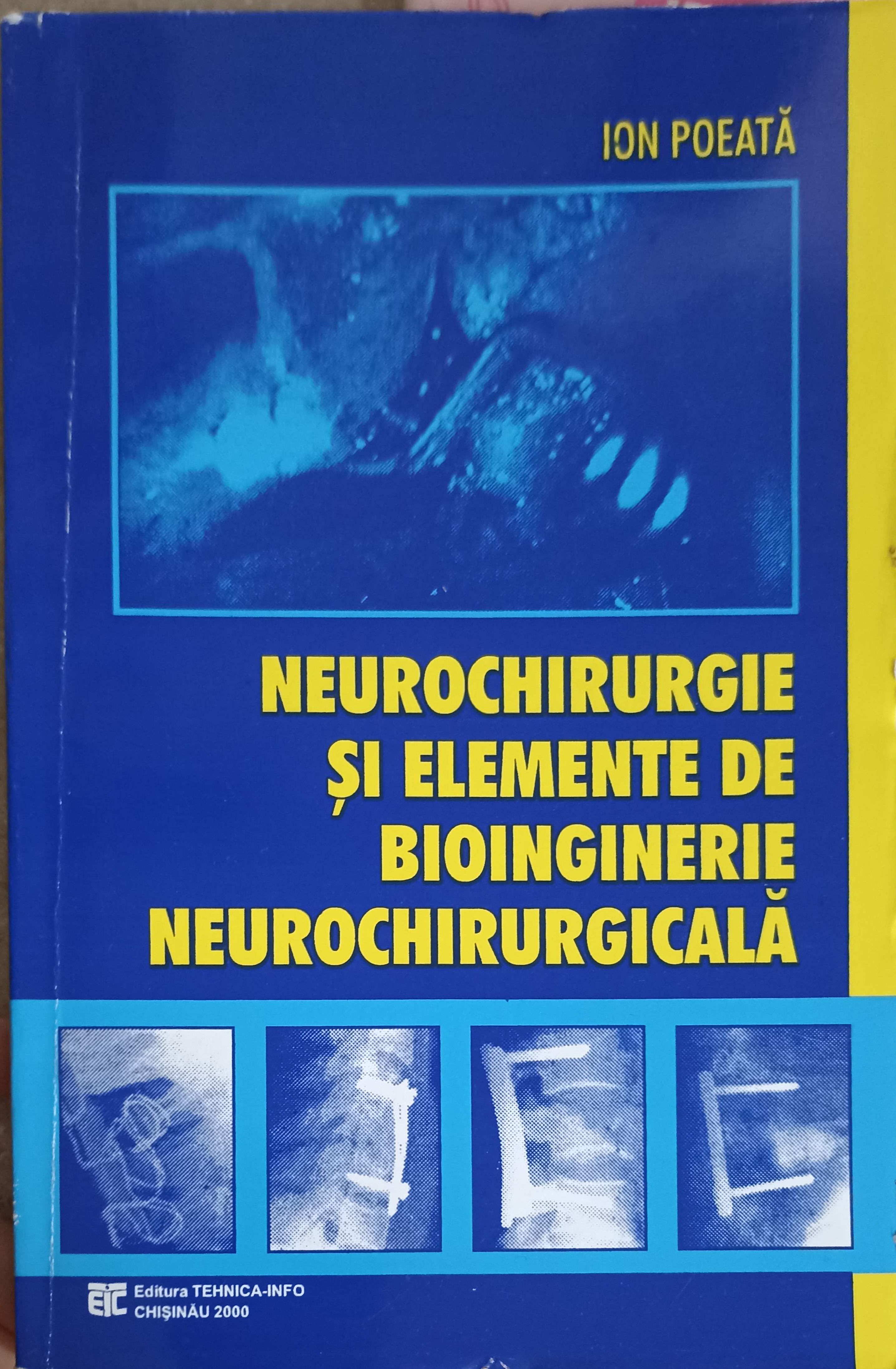 Neurochirurgie Si Elemente De Bioinginerie Neurochirurgicala